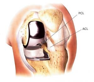 Jiffy Knee™ Subvastus Quad-Sparing Partial Knee Replacement - Dr